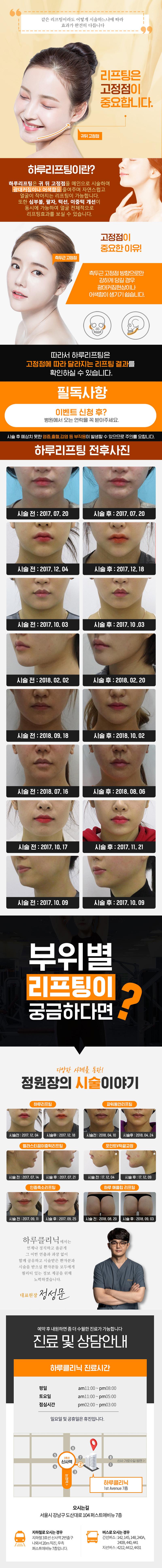 턱라인 처짐과 볼처짐을 개선하는 하루리프팅 시술로, 딤플이나 광대 확장 없이 자연스러운 얼굴 윤곽을 완성하는 77만원 프리미엄 리프팅 시술