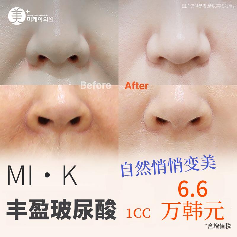 MI·K 玻尿酸填充 1cc