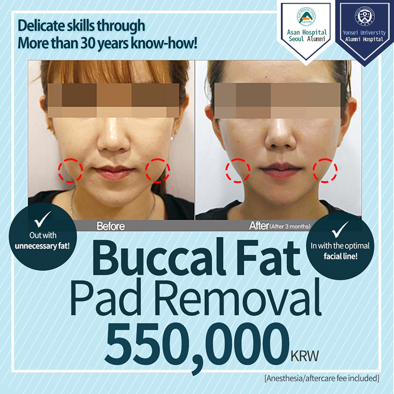 Buccal Fat Pad Removal