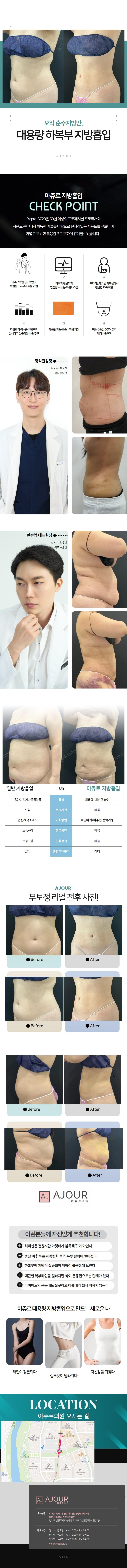 경기 남양주 아쥬르의원의 하복부 지방흡입 시술 상품으로, 125만원에 제공되는 맞춤형 지방흡입 프로그램