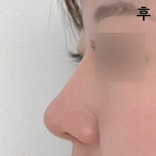 後