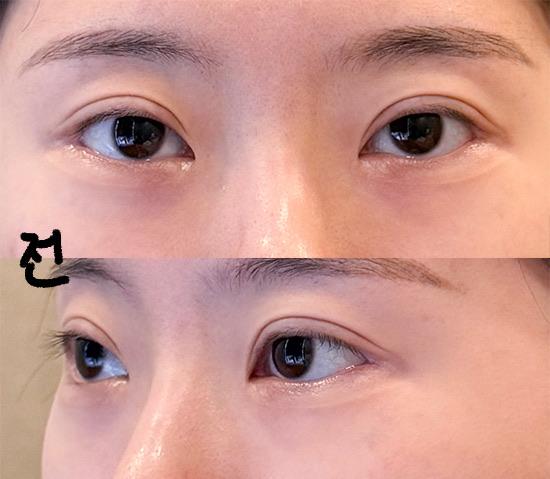 Before