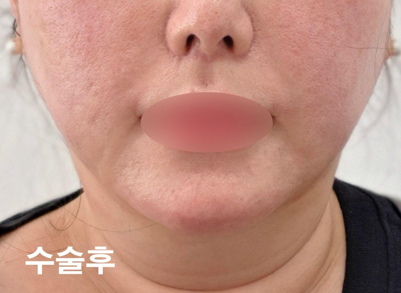 後