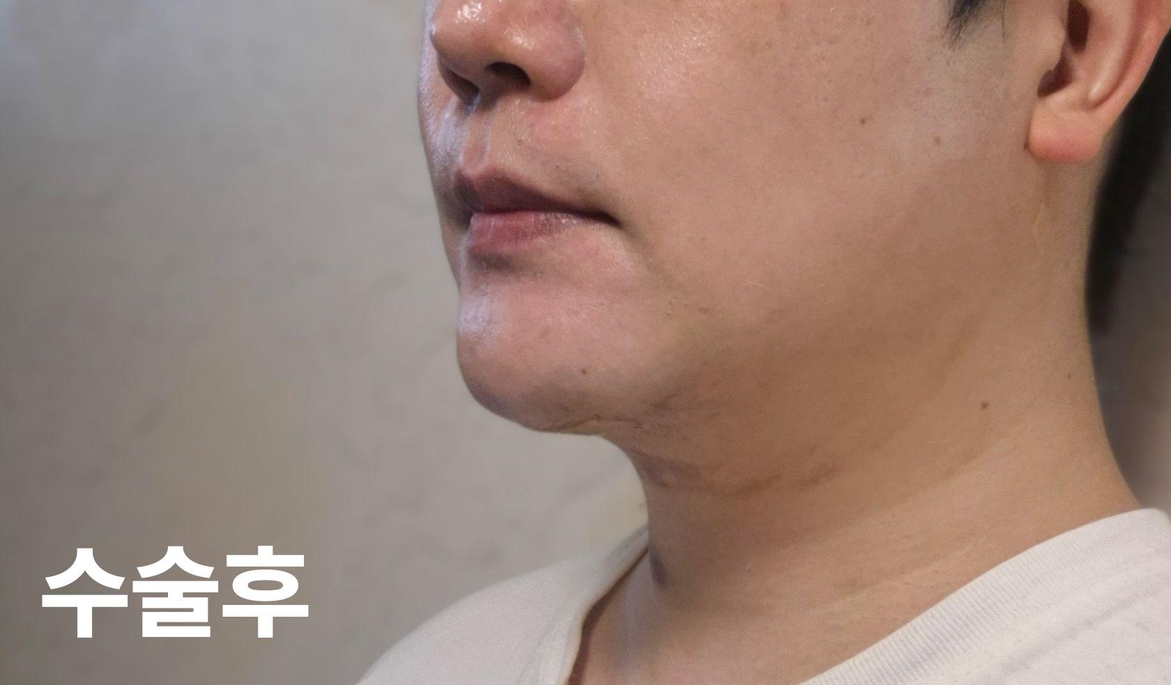 后